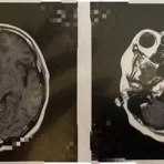 私が体験した抗がん剤の副作用の覚書と対策