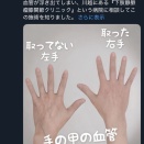 【悲報】美容界隈、ついに『血管』除去整形まで流行り始める