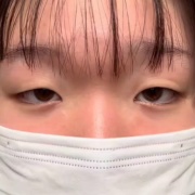 整形した一重女子、手術から1ヶ月後とんでもないことになる・・・