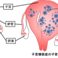 子宮腺筋症の治療