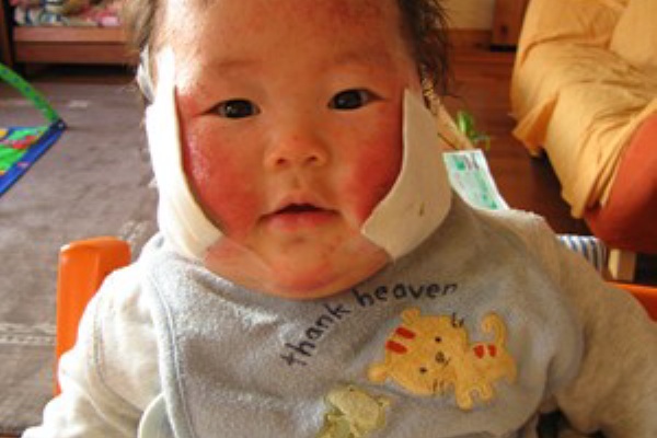 新版 仲良きことは美しきかな 湿疹の状態