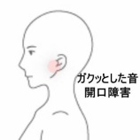 『硬いものを食べた後の顎関節音と開口障害 登別室蘭すのさき鍼灸整骨院 症例報告』の画像