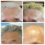 膀胱がん　まさかソコですか！