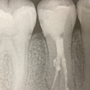 複雑な根管　その6