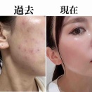 【花粉でかゆかゆお肌をレスキュー】