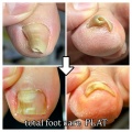 巻き爪補正症例