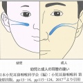 中耳炎抗生物質適応