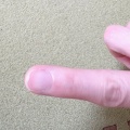 爪と指の間って、痛いんだよね