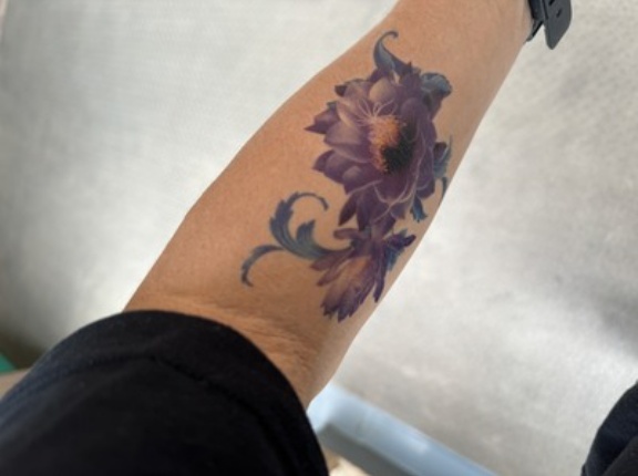 【警告】タトゥー除去、行ってきた結果…