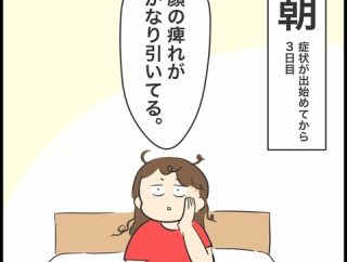 帯状疱疹になりました⑥（完）