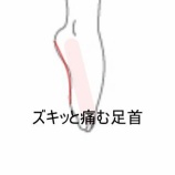 『ランニング後に生じた右足首小指側のズキッとした鈍痛と背屈制限 登別室蘭すのさき鍼灸整骨院 症例報告』の画像