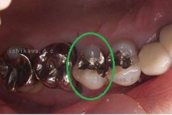 歯と歯の間の虫歯と 銀歯による歯の変色 Dr イチローのホップ ステップ ジャンプ