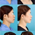 フェイスリフトのパーツモニターさま　術後6ヶ月