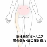 『腰椎椎間板ヘルニアによる腰から足のズキズキとした痛みと痺れで眠れない  登別室蘭すのさき鍼灸整骨院　症例報告』の画像