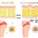 セルライトケアについて