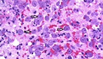 【恐怖】水道水で鼻うがいをしていた女性、脳を食べるアメーバに感染して死亡