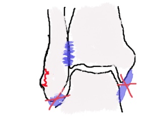 松葉杖卒業!!ズレるの意味がやっと解りました♪