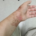 ヤケドのケガの経過観察7※途中患部の写真もあるので閲覧にはご注意下さいませ。