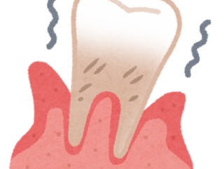 【相談】急性歯周病になって歯茎に膿が溜まり、歯医者で手術した。膿が出て痛みから解放された。しかし、その２日後
