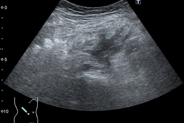 1記事3分 超音波検査士けんしんのエコーノート 19年11月