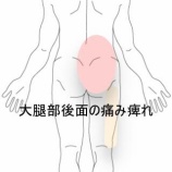 『立位時に増悪する右下肢のしびれと疼痛 登別室蘭すのさき鍼灸整骨院 症例報告』の画像