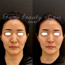 ヒアルロン酸注入＊３D写真比較