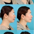 フェイスリフト、ネックリフトのパーツモニターさま 術後1年2ヶ月