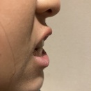 受け口歯列矯正　中1娘病院を変えて再矯正