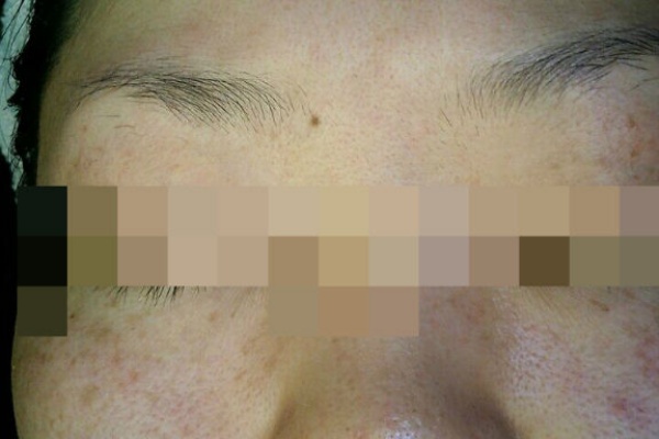 手湿疹 脱ステロイド そして角質培養 画像つき角質培養日記