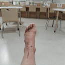 明日退院します。