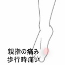 バドミントンで悪化した足親指の痛み　登別室蘭すのさき鍼灸整骨院　症例報告　
