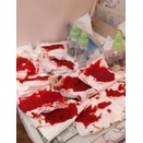 ＜６＞続き・日記（滲出液仮説）