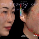 新時代の糸リフト＊アプトスヴィサージュエクセレンス３D写真