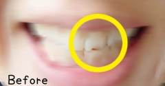 前歯が欠けた！治療費はいくら？保険で直せる？実際に歯医者に行ってきた結果