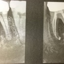 根っ子の病気と歯周病　その7
