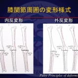『膝周囲骨切り術（Around the knee osteotomy）』の画像