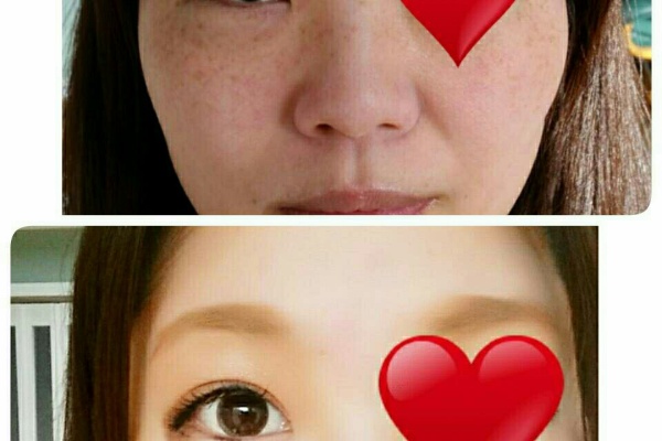 手湿疹 脱ステロイド そして角質培養