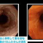 【朗報】食道のがん細胞をウイルスを使って破壊する世界初の治療薬、上野厚生労働大臣が製造販売を承認　薬を投与した結果18ヶ月以内に半数の患者のがんが消失！（動画あり）