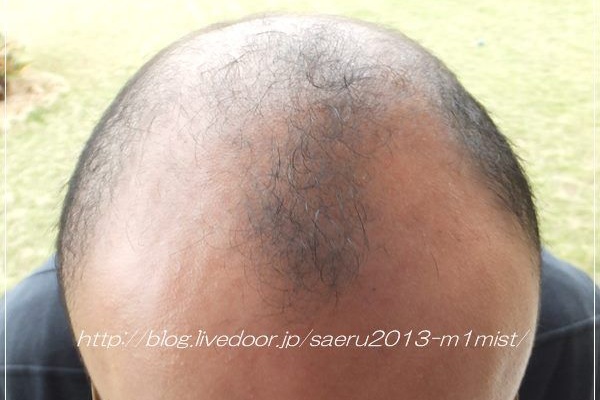 M 1毛髪ミスト 体験談 頭皮トラブルゼロ育毛