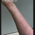 PTSD公表の渡邊渚「また顔の上半分真っ赤っか　再燃してる＆#65374;はぁぁ」激変顔面＆「パンパン」腕の写真公開