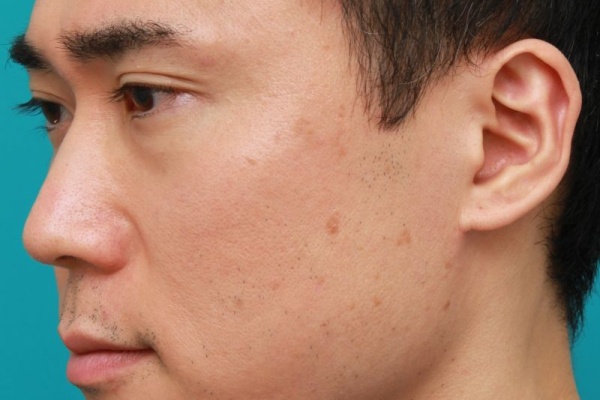 高須クリニック高須幹弥の美容整形症例画像写真集 シミ治療の症例写真