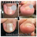 巻き爪ケア症例