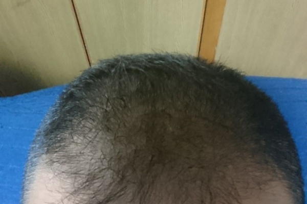 ハゲ坊主のブログ ミノキシジルタブレット フィンペシアorデュタス 亜鉛 L リジン Aga 18年05月