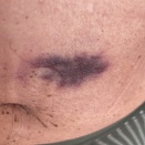 昨日の注射痕です