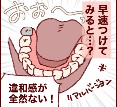 大人の歯科矯正卒業か…？とっくに入れ歯が出来ている話