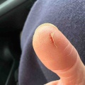ピーラーで切った親指の経過