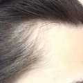 術前・術後写真、発毛後の心境、全体としての感想