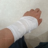 『ヤケドのケガの経過観察5※途中患部の写真もあるので閲覧にはご注意下さいませ。』の画像