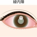 恐怖！　緑内障