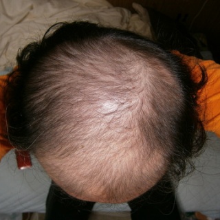 ハゲ頭からのプロペシア使用で効果がどれほどでるのか（ホントに発毛するのか？）